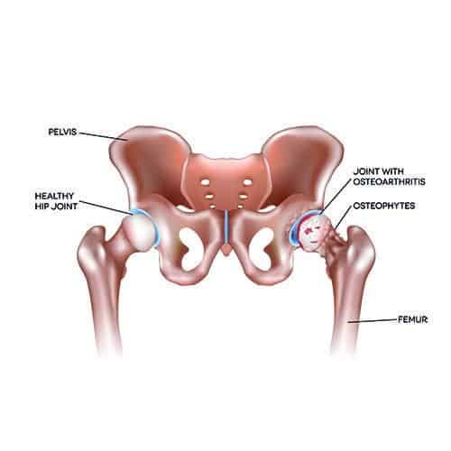 Hip arthritis – Osteoarthritis – Pain Treatment Specialists