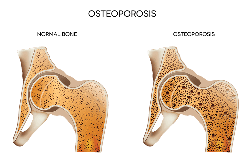 Know more about what causes osteoporosis | Get advice on how to treat osteoporosis