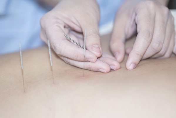 Acupuncture is an ancient pain relief technique that has been perfected over the centuries. While some people remain skeptical about its effectiveness, it is now recognized and highly regarded by the medical community.
