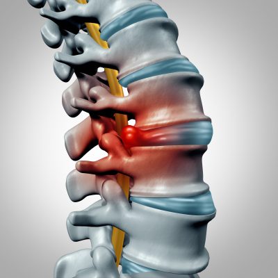 What is the best solution for herniated discs? How do you know if you should see your pain doctor? We review treatment options for you and elaborate on what type of specialist to seek out if your symptoms warrant medical attention.