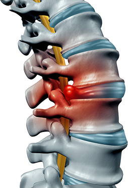 Back pain due to Lumbar Herniated Discs