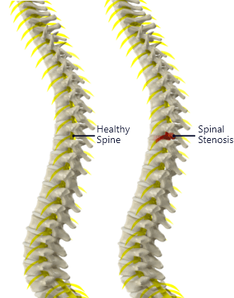 Spinal stenosis vs healthy spine -mobile