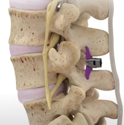 Corrected-vertebrae-with-the-Vertiflex