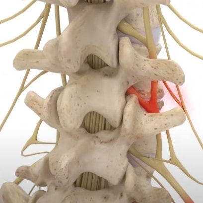 Spinal-stenosis