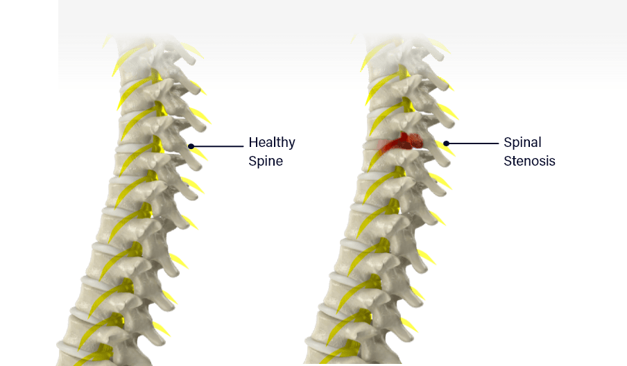 Healthy Spine and Spinal Stenosis