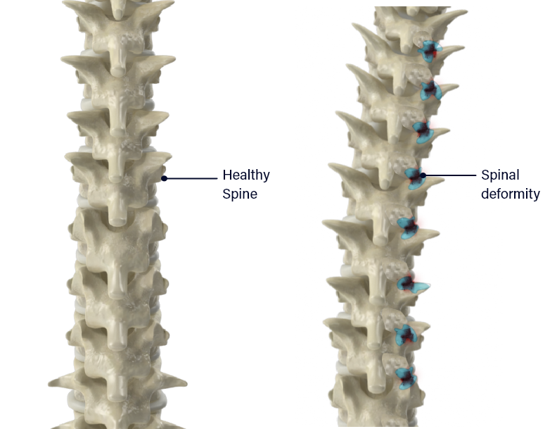 Healthy Spine and Spinal Stenosis