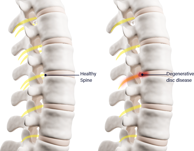 Harvard Trained Pain Doctors | Degenerative Disc Disease – Primary ...
