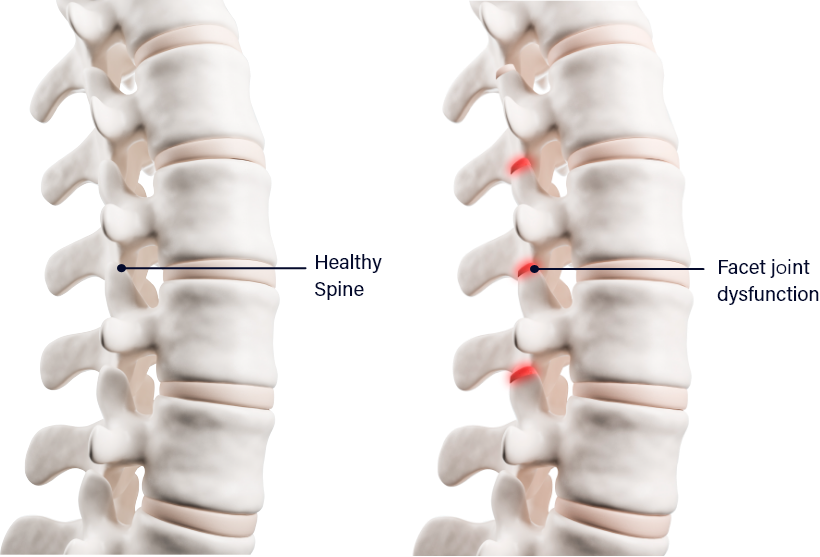 Healthy Spine and Spinal Stenosis