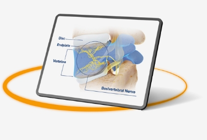 Intracept System