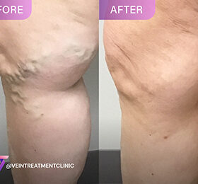 Learn the effectiveness and benefits of injections for targeted pain relief and explore minimally invasive treatments for chronic pain at Pain Treatment Specialists.